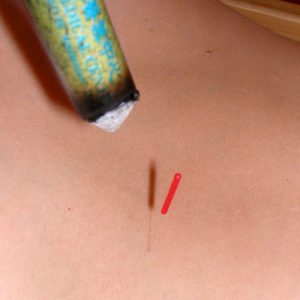  Akupunktur, Moxatherapie und Schröpfverfahren